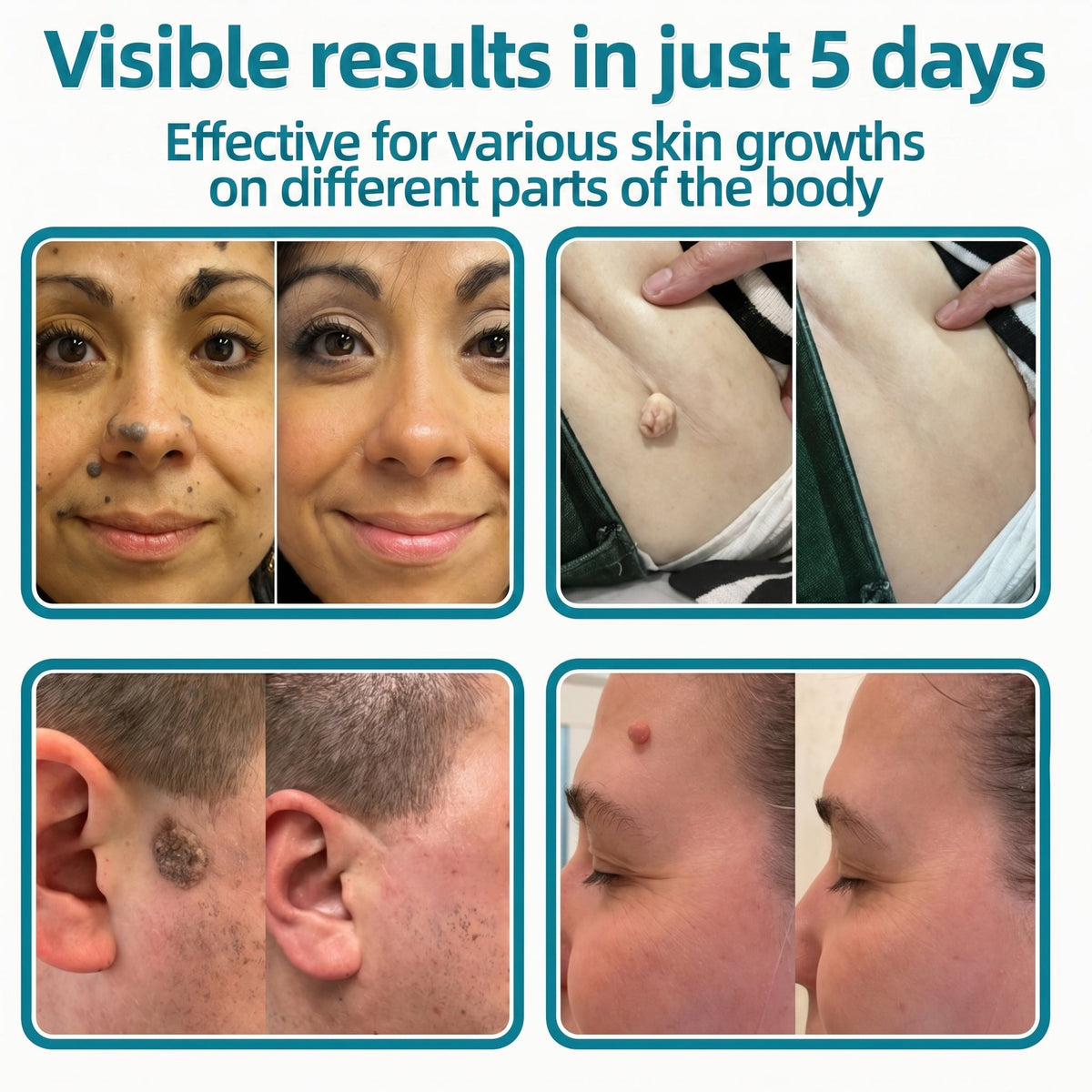 🇳🇿✅𝐇𝐞𝒂𝒍𝗿𝗶𝙯𝙚®2-in-1 Microneedle & Hydrocolloid Patch🎉| Removes Raised Moles, Acne, Flat Warts & Skin Tags | Helps Improve Wrinkles, Scars & Blemishes | Invisible Patches for Face & Body