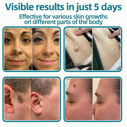 🇳🇿✅𝐇𝐞𝒂𝒍𝗿𝗶𝙯𝙚®2-in-1 Microneedle & Hydrocolloid Patch🎉| Removes Raised Moles, Acne, Flat Warts & Skin Tags | Helps Improve Wrinkles, Scars & Blemishes | Invisible Patches for Face & Body