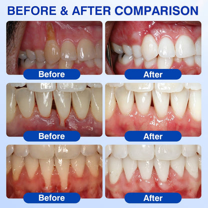 🇳🇿👨‍⚕️🦷🎉 CureVivo® GumRevive Periodontal Repair Gel🔥