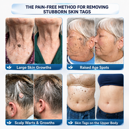 CureVivo® 𝟕-𝐃𝐚𝐲 𝐒𝐤𝐢𝐧 𝐓𝐚𝐠 & 𝐒𝐩𝐨𝐭 𝐑𝐞𝐦𝐨𝐯𝐚𝐥 𝐂𝐫𝐞𝐚𝐦 (𝐏𝐚𝐢𝐧𝐥𝐞𝐬𝐬 𝐅𝐨𝐫𝐦𝐮𝐥𝐚 – 𝐍𝐨 𝐒𝐜𝐚𝐫𝐬)❤️