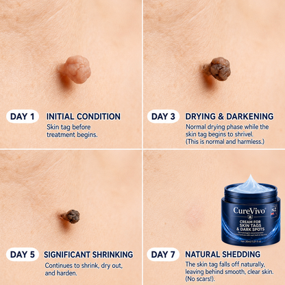 CureVivo® 𝟕-𝐃𝐚𝐲 𝐒𝐤𝐢𝐧 𝐓𝐚𝐠 & 𝐒𝐩𝐨𝐭 𝐑𝐞𝐦𝐨𝐯𝐚𝐥 𝐂𝐫𝐞𝐚𝐦 (𝐏𝐚𝐢𝐧𝐥𝐞𝐬𝐬 𝐅𝐨𝐫𝐦𝐮𝐥𝐚 – 𝐍𝐨 𝐒𝐜𝐚𝐫𝐬)❤️