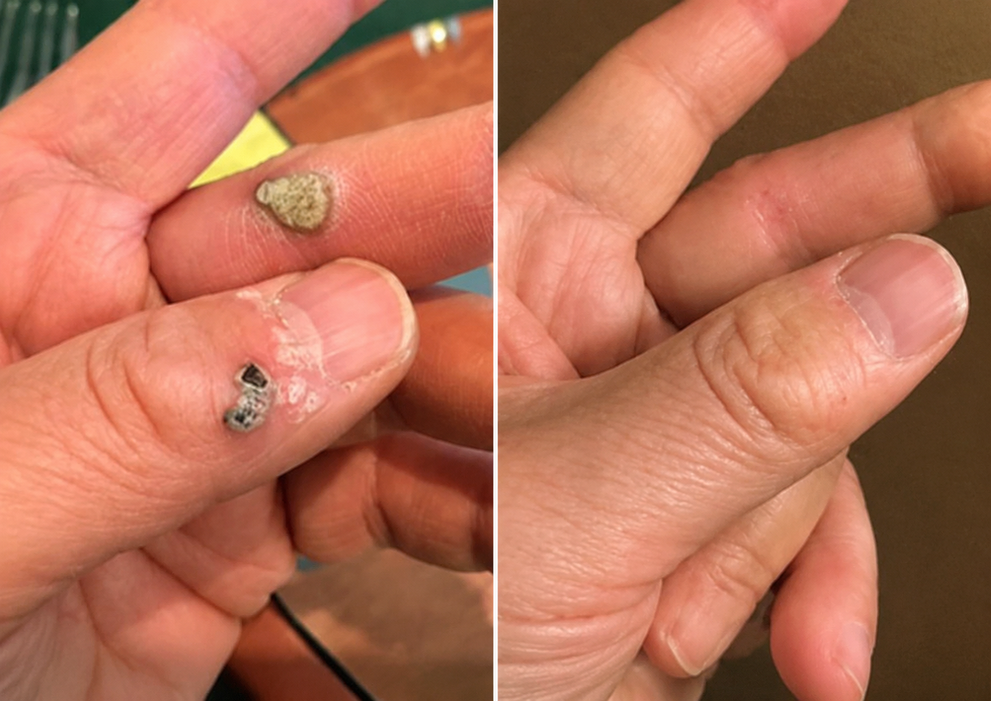 🇳🇿✅𝐇𝐞𝒂𝒍𝗿𝗶𝙯𝙚®2-in-1 Microneedle & Hydrocolloid Patch🎉| Removes Raised Moles, Acne, Flat Warts & Skin Tags | Helps Improve Wrinkles, Scars & Blemishes | Invisible Patches for Face & Body