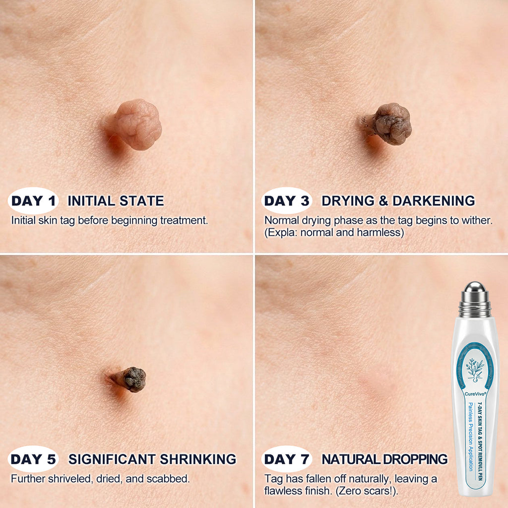 🌸CureVivo® 7-𝐷𝑎𝑦 𝗧𝐚𝐠 & 𝗦𝗽𝐨𝐭 𝐄𝐫𝒂𝒔𝒆𝒓✅🎉(Zero Pain, Zero 𝐒𝐜𝐚𝒓𝒔 Rollerball)