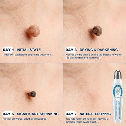 🌸CureVivo® 7-𝐷𝑎𝑦 𝗧𝐚𝐠 & 𝗦𝗽𝐨𝐭 𝐄𝐫𝒂𝒔𝒆𝒓✅🎉(Zero Pain, Zero 𝐒𝐜𝐚𝒓𝒔 Rollerball)