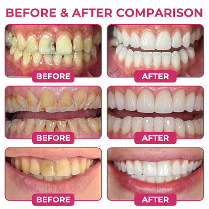 🇳🇿CureViVo® DenPerm Cavity-Repair Natural Enamel Filling Gel