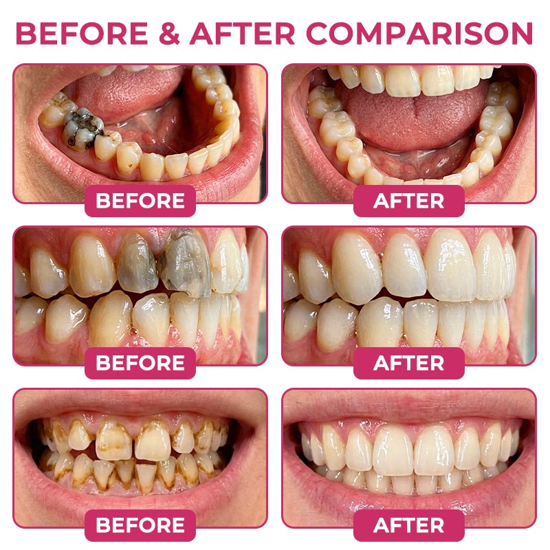 🇳🇿CureViVo® DenPerm Cavity-Repair Natural Enamel Filling Gel